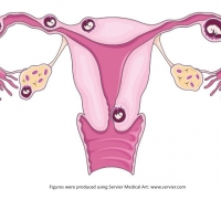 Ectopic pregnancy